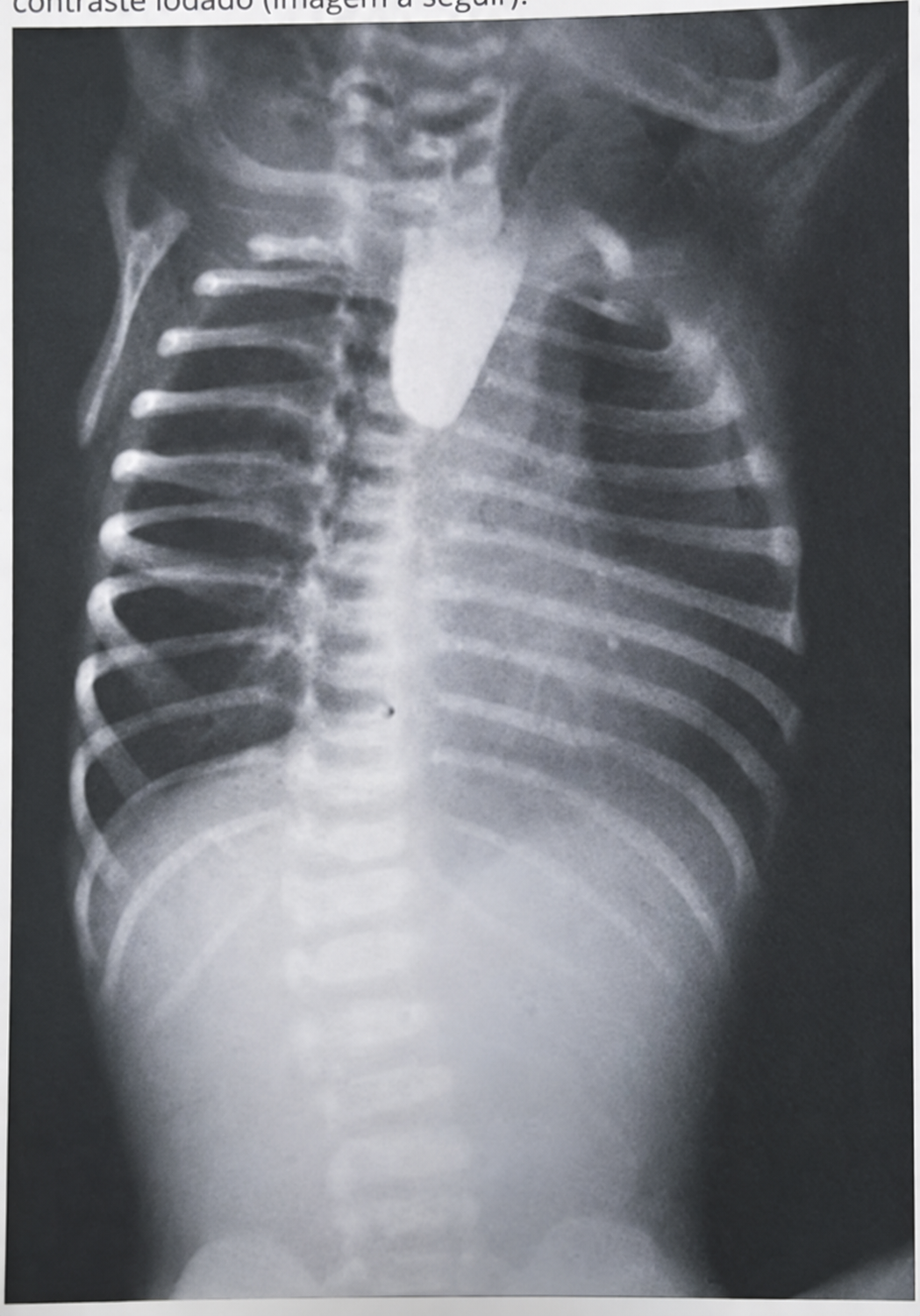 Imagem da questão de Cirurgia Neonatal e Emergências