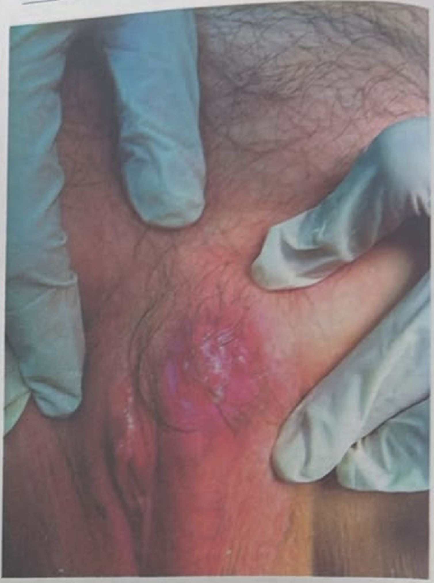 Imagem da questão de Câncer vulvar